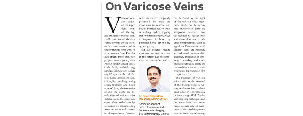 On Varicose Veins