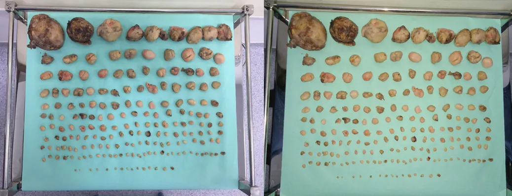Tumor Removal Milestone